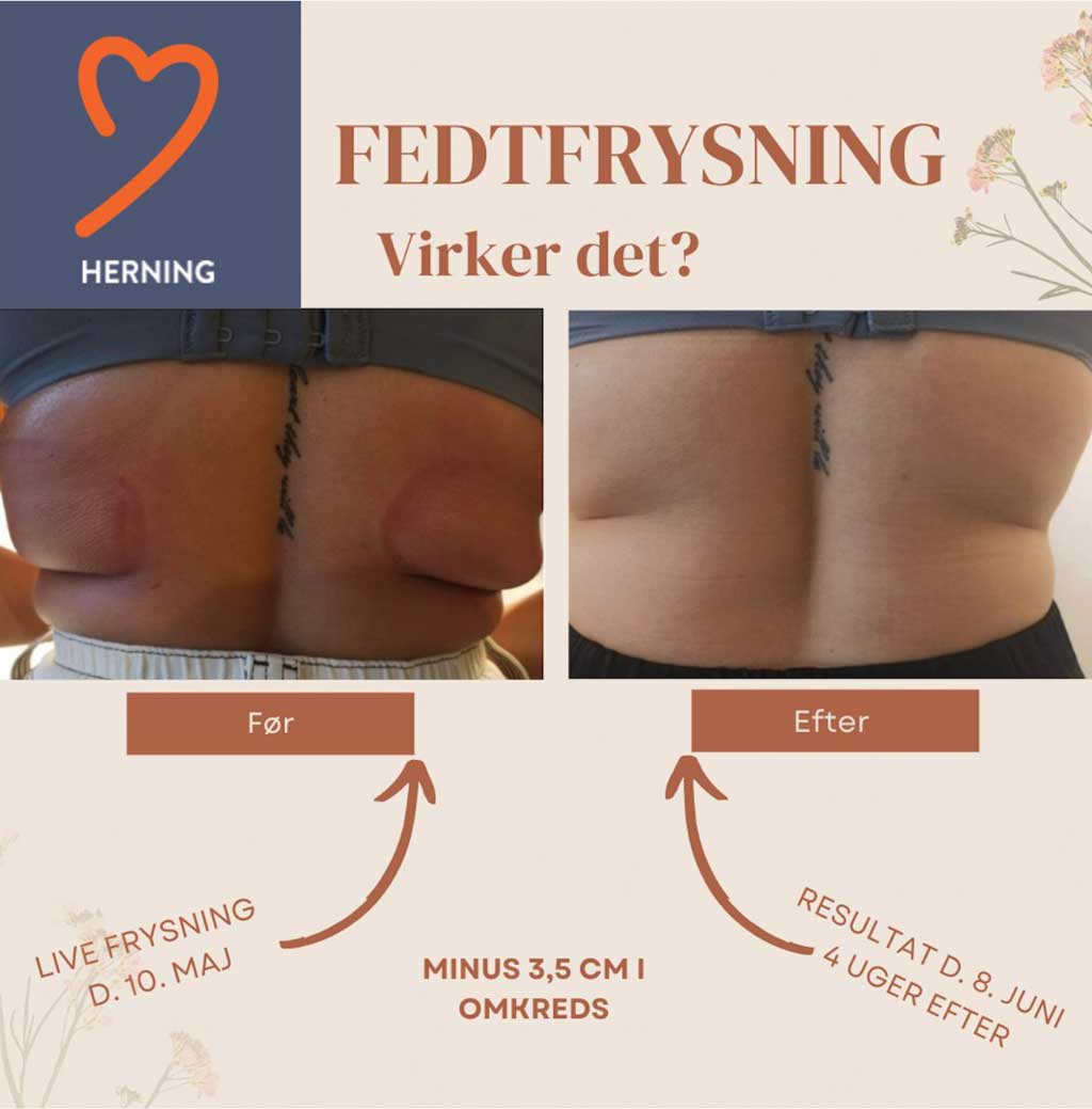 Fedtfrysning
